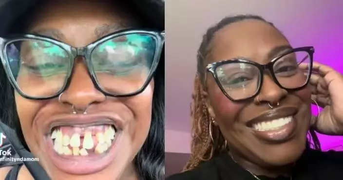 患牙周病牙齒狂脫落 美網紅飽受病痛折磨更遭網暴 全口植牙後重拾自信