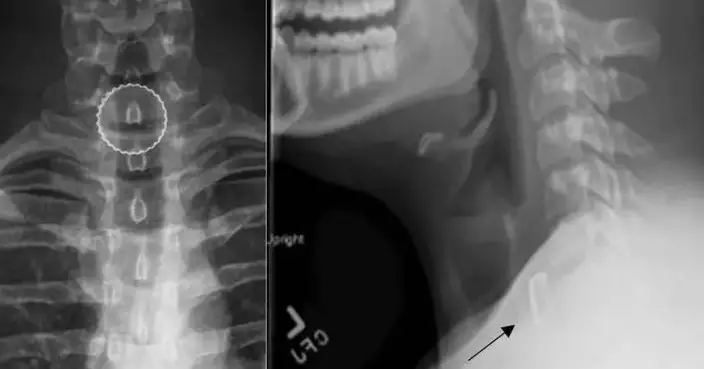 美19歲男飲啤酒1小時後呼吸異常 送院驚揭誤吞瓶蓋卡食道不自知