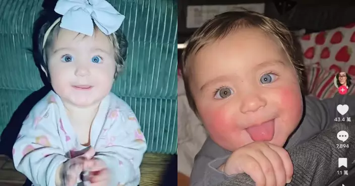 長三色眼頭髮稀疏捲曲 美國女嬰疑患嵌合體綜合症 體內至少有兩套DNA