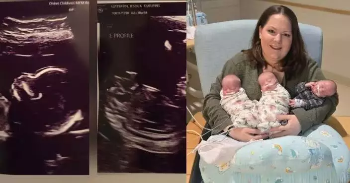 當地第二宗！紐約孕婦自然受孕誕5胞胎 獲30人醫療團隊全力支援母嬰平安