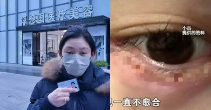杭州女面部填充嚴重過敏 修復再遭美容院職員粗暴擠爆臥蠶視力受損