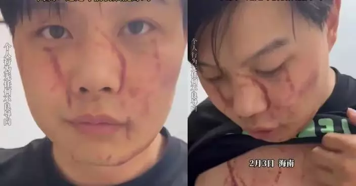 出差憂醉酒妻出事 海南男連夜返家遭妻當賊痛毆遍體鱗傷