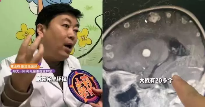 老屋大掃除後高燒17天 河南女童就醫揭感染真菌腦部現逾20個「坑洞」