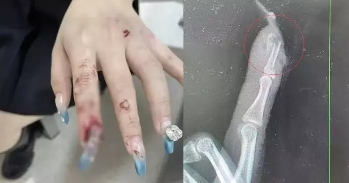 貪靚貼延長甲片 杭州女騎車跌倒用手撐地致手指骨折甲床斷裂需手術修復