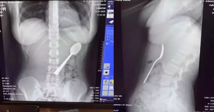 食乳酪突遭愛犬撲上身 比利時女受驚誤吞17CM匙羹 需做胃鏡取出