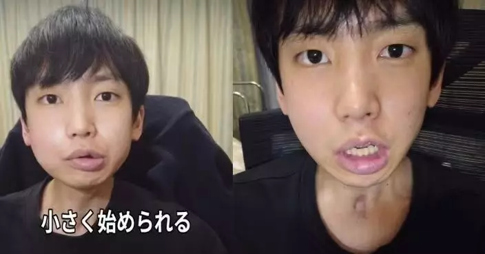 日25歲男口腔潰瘍3周未癒確診舌癌 切半邊舌頭仍2度復發 公開經歷勉勵病友