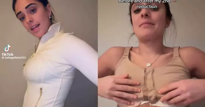 感胸部過大影響生活 蘇格蘭女花錢縮胸6周後「打回原形」勁無奈