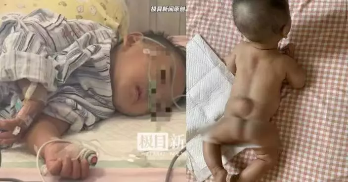 女嬰半歲確診脊柱裂 瀋陽母追查揭產檢大排畸醫生無檢查資質