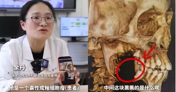 右臉腫脹牙齒鬆動求醫 杭州11歲男童檢查揭頜骨良性腫瘤險毀容