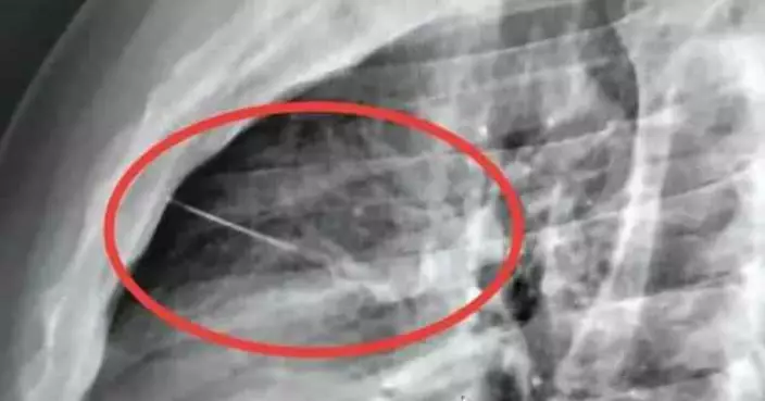 泰男躺床胸痛難耐 照X光驚揭7CM縫衣針插入胸腔險刺穿心臟