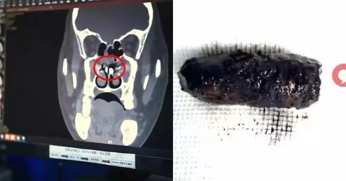 鼻腔惡臭流膿3個月以為鼻竇炎 湖北男求醫遭揭3CM螺絲釘藏鼻腔40年