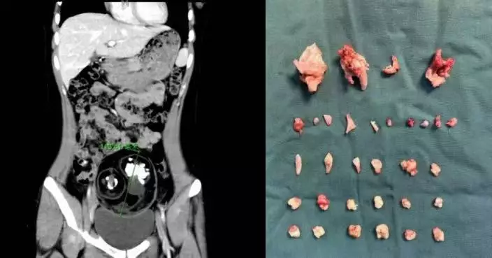 跳操突劇烈腹痛 湖南18歲女求醫揭下腹藏12CM畸胎瘤 內含24顆牙齒