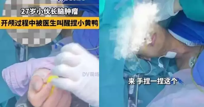 廣州男開顱手術中被喚醒捏玩具鴨及答問題 醫生：為精準保護腦部功能區