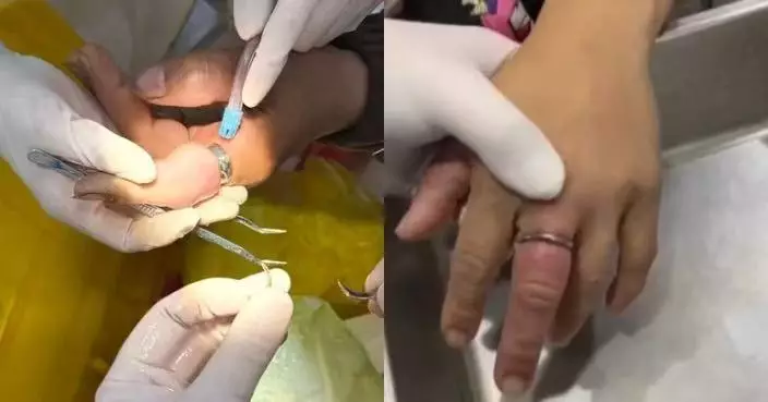 戒指卡手指致腫脹發黑 內地女求助消防無果獲建議改去口腔科終成功取下