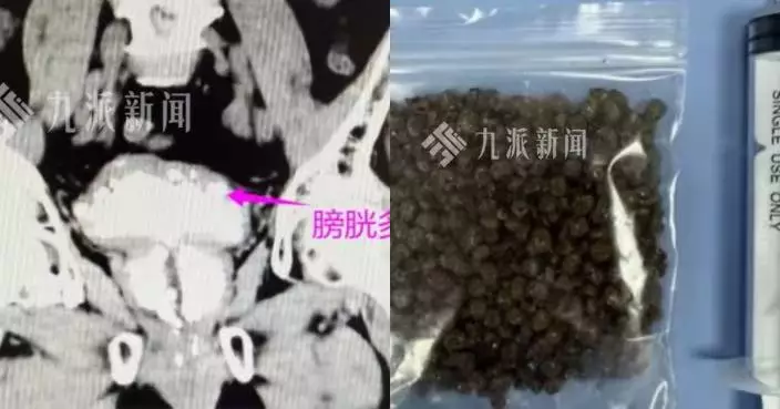 30年前尿道手術留後患 廣州翁長年排尿困難 求醫遭揭膀胱塞逾600顆結石