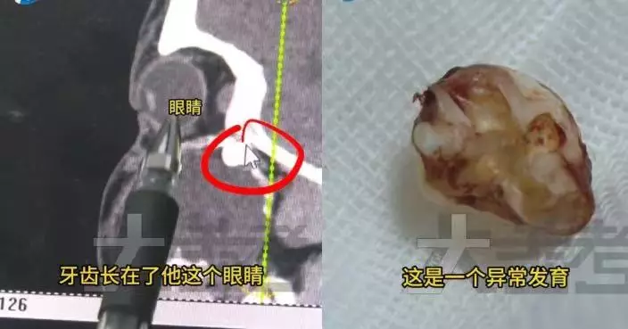 河南少年左臉腫脹嘴歪求診 醫揭智齒異位生長被囊腫推至眼窩