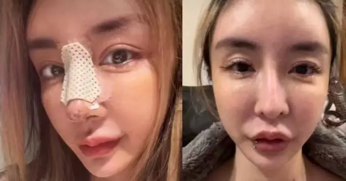18歲起狂動刀整形 台女網紅自曝長期陷「容貌焦慮」 鼻子重整7次仍不滿意
