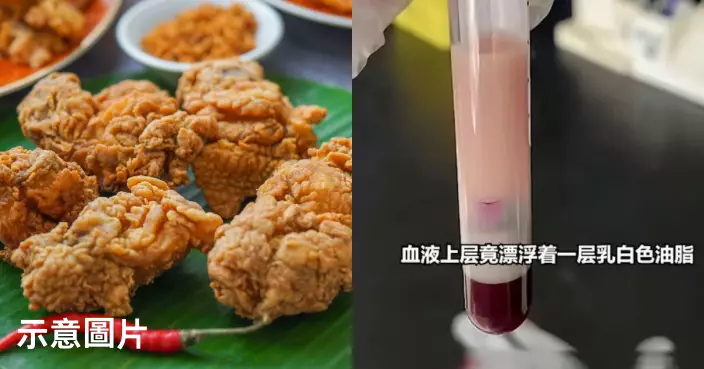 長期嗜吃高脂食物 浙江男腹痛送院抽血驚見血液漂浮如「豬油」乳白油脂