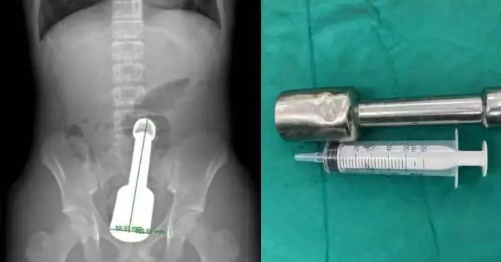 劇烈腹痛被送院 越南15歲少年照X光遭揭18CM金屬棒卡直腸險撐破腸道