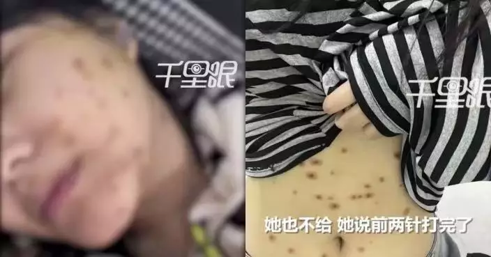 買貓當生日禮物 江蘇女飼養一周染「貓癬」全身冒紅疹潰爛求償未果