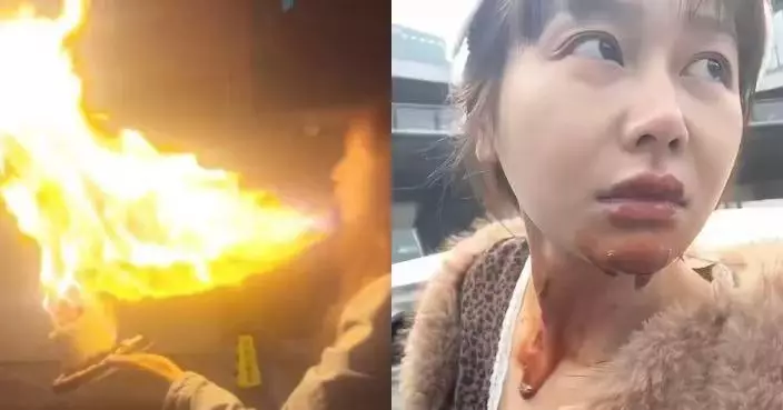 切勿模仿！慶生朝點燃蠟燭蛋糕口噴白酒造特效 內地女遭火舌直撲臉頸被燒傷