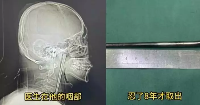 誤吞12CM金屬筷驚開刀忍足8年 大連男咽喉劇痛求醫才取出