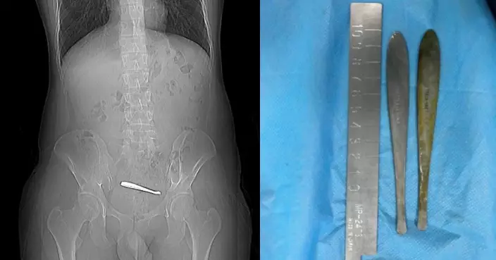 西安男腹痛1周始求醫 遭揭腸道內藏兩匙羹險穿孔 醫生花1小時取出