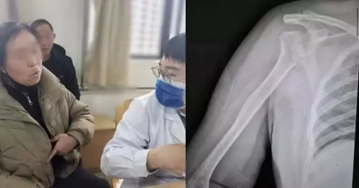 無跌倒無外傷 河南婦熟睡中右肩突粉碎性骨折 醫生檢查揭隱藏多年癲癇作祟