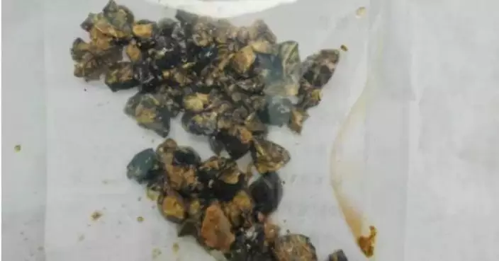 工作繁忙長期飲食不規律 南京女腹痛就醫遭揭膽囊藏逾60顆結石