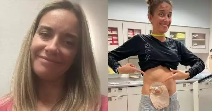 排便異常出血求醫遭誤診產後症狀 美婦拖6年確診大腸直腸癌三期