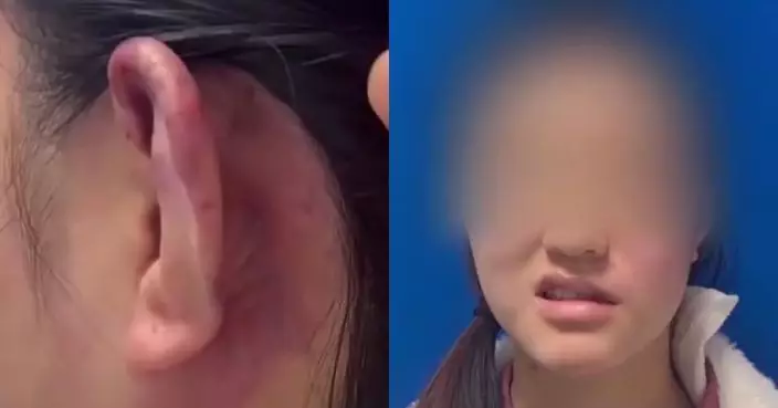 內地醫美「精靈耳」整形風潮藏禍 滬少女一針致面癱終身殘疾