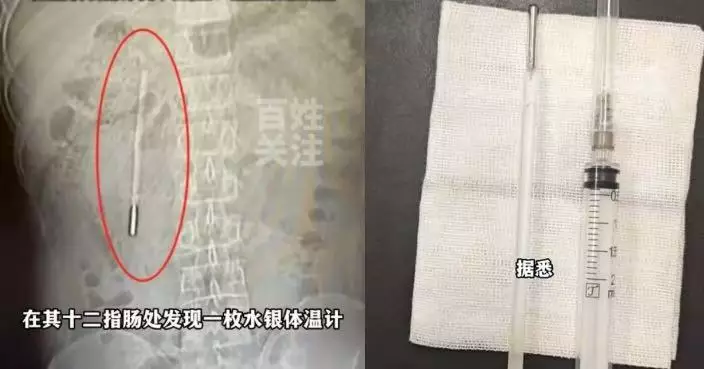 溫州32歲男腹部不適求醫遭揭體內藏水銀體溫計 12歲誤吞滯留20年