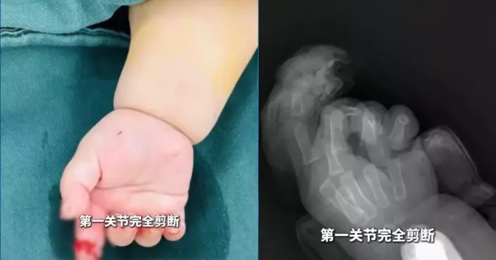 山東女拆快遞誤剪斷7個月大女兒食指 丈夫梳化縫隙尋回斷指送醫成功接回