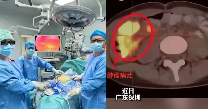 腹痛半年誤當痛經 深圳14歲少女求醫確診晚期結腸癌 醫揭家族遺傳病因