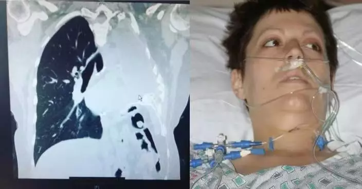 童年愛著父親工地外套埋隱患 美國女患肺癌曾被告知僅餘15個月壽命 致命原因曝光