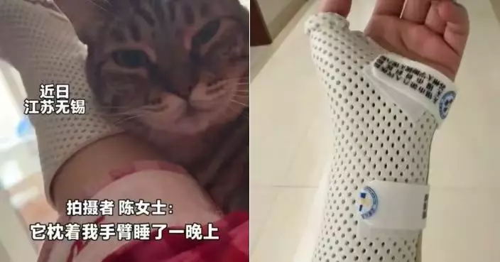 手臂遭15斤愛貓枕一晚酸麻不已 江蘇女飼主3日後求醫驚揭手腕骨折