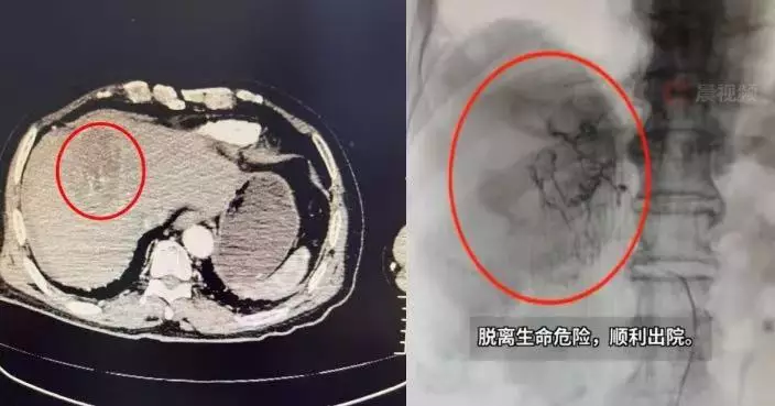 患慢性乙型肝炎逾10年 湖南6旬婦跳廣場舞突腹痛 送院揭肝腫瘤破裂出血險休克