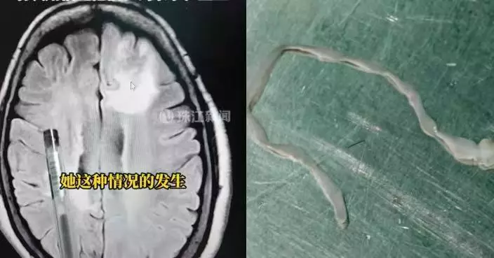 頻繁抽搐發冷一度以為患腦瘤 廣東婦剃发準備開顱前揭腦內藏8CM活蟲