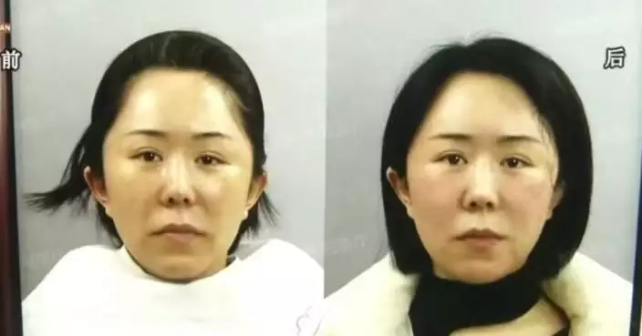 浙女花2.3萬做醫美臉部凹陷變形 協商退款更遭工作人員羞辱