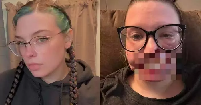 癲癇發作失意識倒臥家中 美國女遭飼養4年比特犬攻擊幾近毀容需面部重建