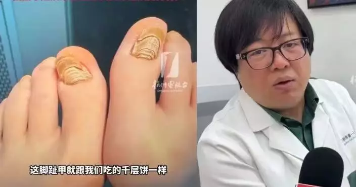 雙腳冰冷長期著襪瞓覺 杭州女腳甲發黃增厚變「千層糕」確診阻生性甲需拔甲