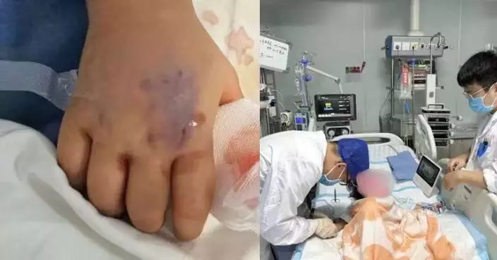 遭眼鏡王蛇咬傷陷「假死」近3日 雲南女童獲醫生精準判斷施血清奇蹟生還