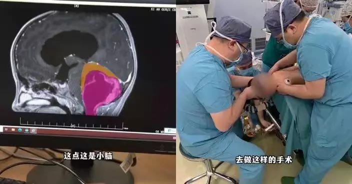 西安女童腦內長蘋果大腫瘤壓迫生命中樞 獲醫生施手術成功切除已康復出院