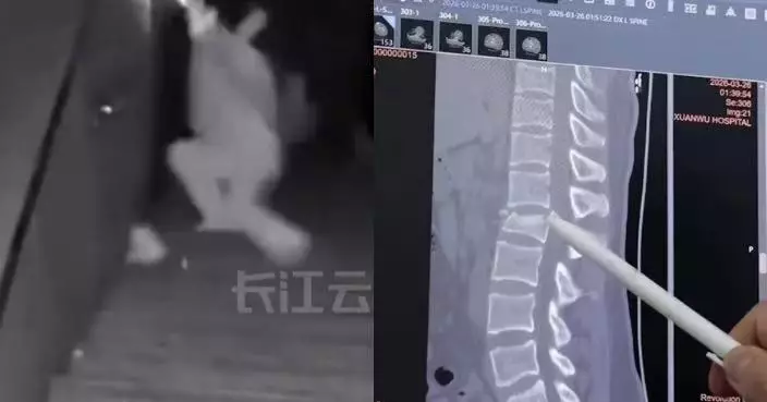 落樓梯掛住睇手機 內地女不慎踩空腰椎爆裂性骨折險癱瘓