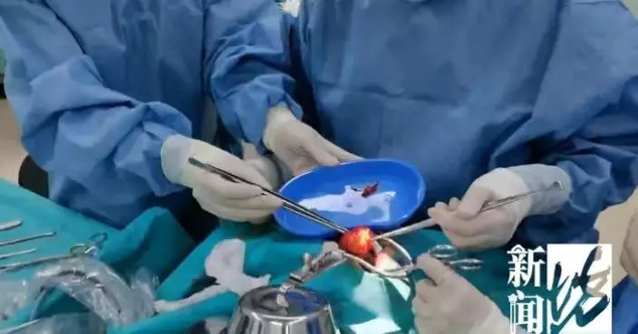 狂打鼻鼾還挑食！北京男童求醫揭咽喉藏6CM畸胎瘤險窒息 疑為雙胞胎胚胎殘留