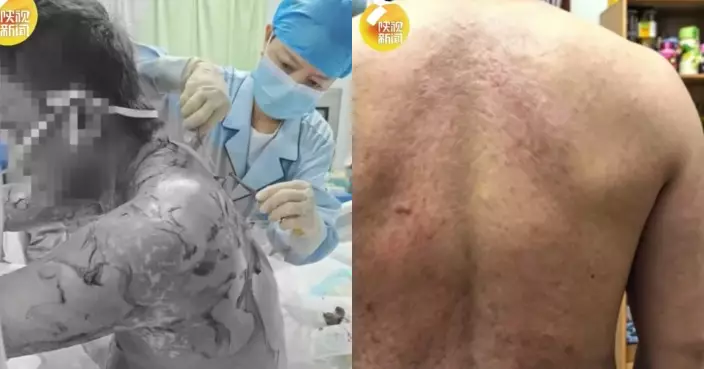 酒後發燒連服布洛芬 西安男全身逾9成皮膚潰爛命危 搶救45日才脫險　