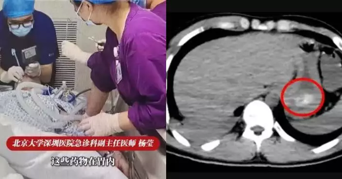 深圳漢酒後誤吞150顆藥 胃現「藥石」急做手術救命 醫揭藥物中毒3迷思