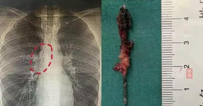 浙17歲少年徵兵體檢遭揭腔藏5CM縫衣針 緊貼大血管逾10年無痛楚無症狀