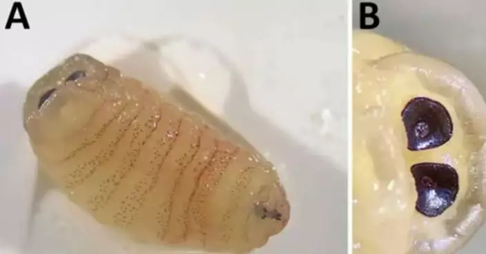 打噴嚏突噴出「活蟲」 希臘女求醫揭鼻竇藏10幼蟲1蟲蛹