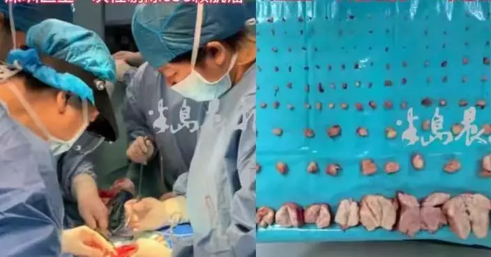 患罕見子宮肌瘤病被勸切子宮 美國女深圳求醫成功剔656顆肌瘤保住生育力